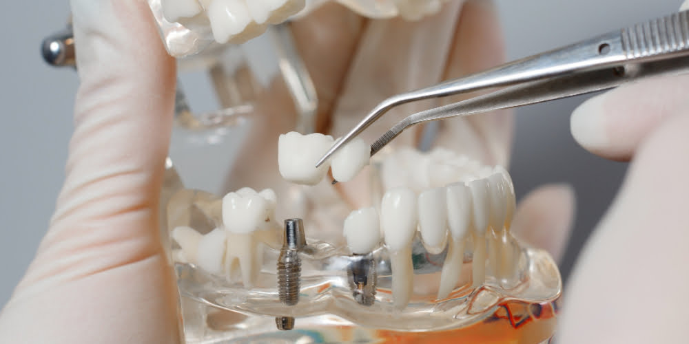 Diş İmplantları ve Hayatımıza Kattıkları