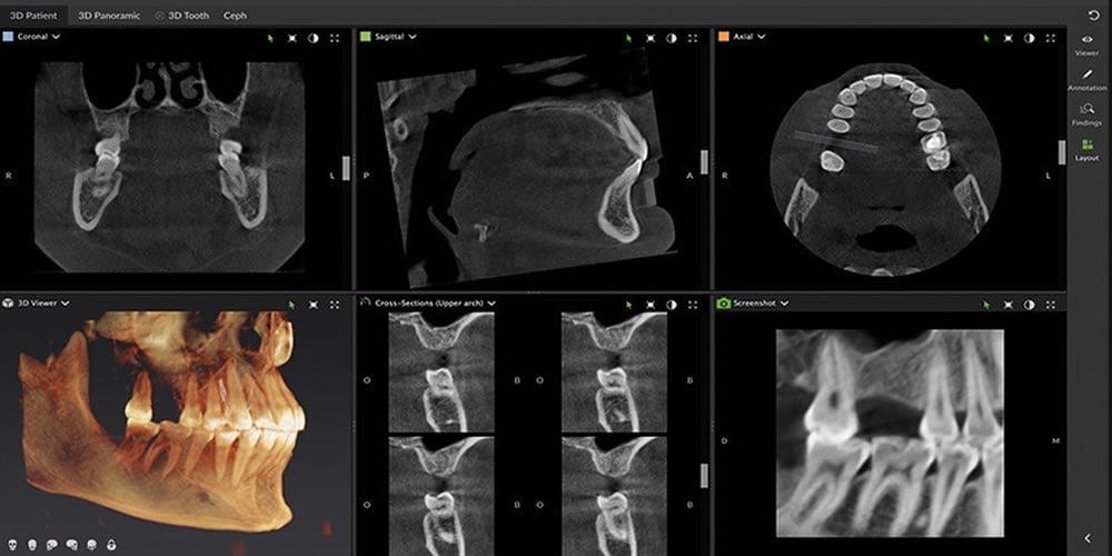 Dental İmplantlar İçin Teknolojinin Yararları