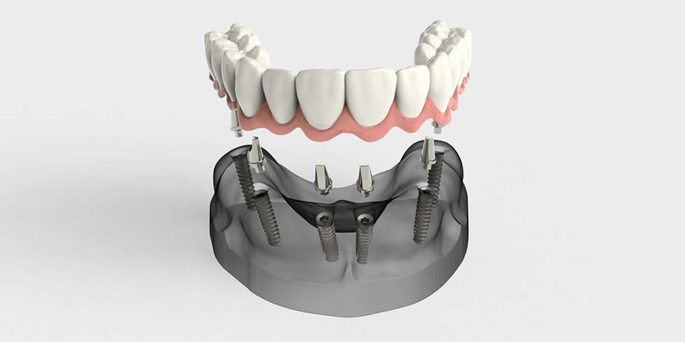 Diş İmplantı Tedavi Süreci
