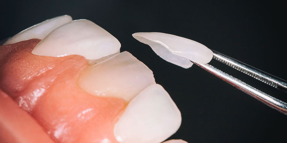 Laminate Veneer Kaplama