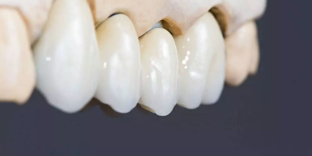 Zirkonyum Kaplamalar Nasıl Yapılır?