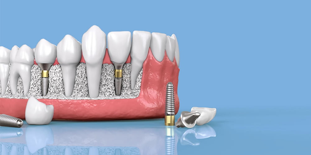 Diş İmplantları Diş Eti Hastalığına Neden Olabilir mi?