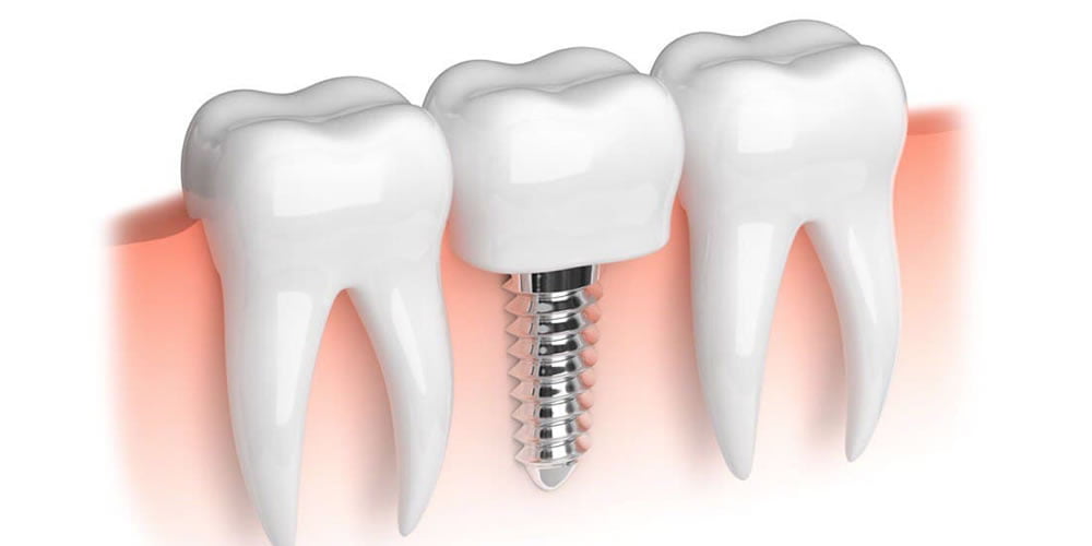 Dental İmplant Osseointegrasyon