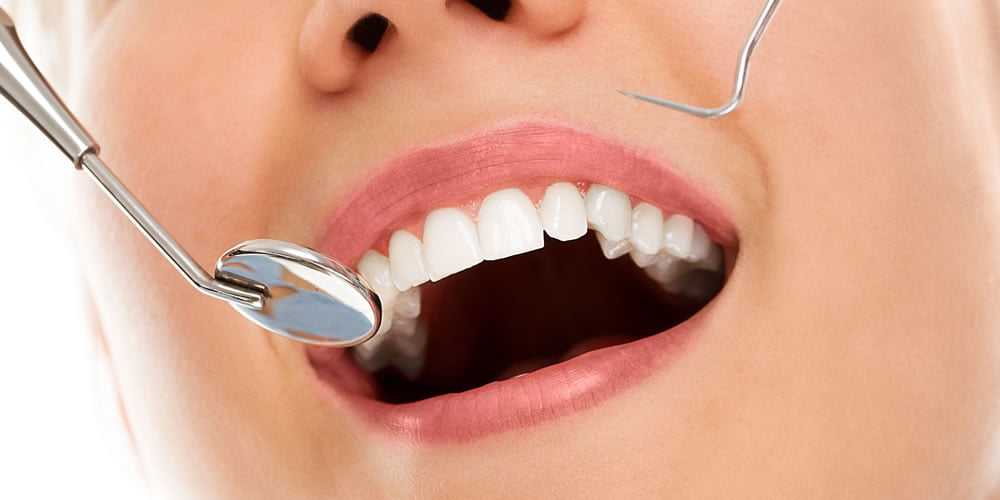 Diş Çürüğü Nedir? Nasıl Tedavi Edilir?