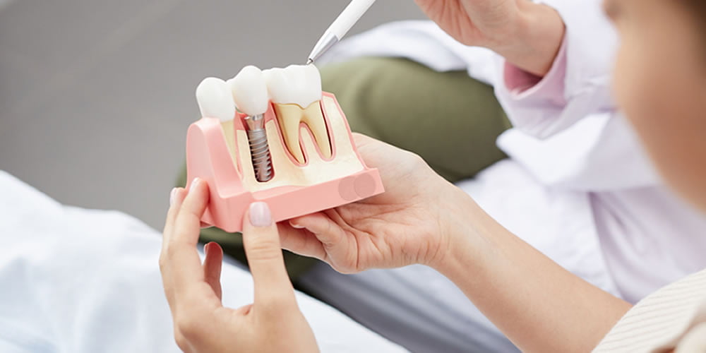 Geleneksel İmplant ve İmmediat Arasındaki Farklar