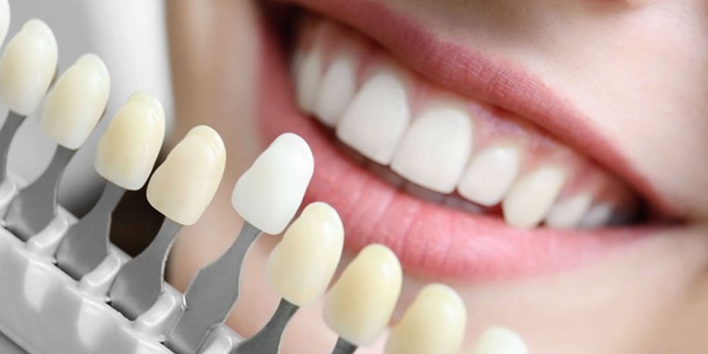 Seramik Kaplama Nedir?