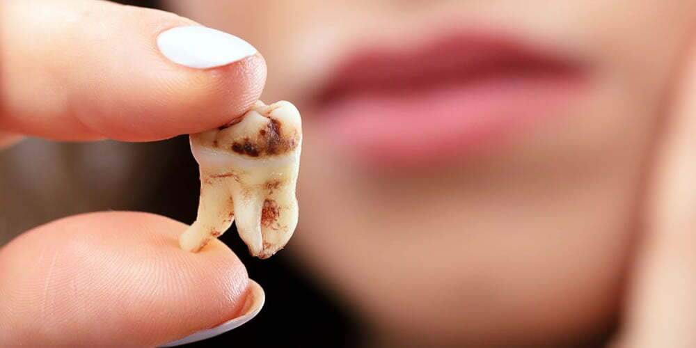 Diş Çürümesi Nedir?
